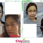 [성형이야기] 지방<b>이식</b> Vs 필러, 나는 어떤 시술을 받아야 할까...