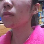 네이****릭 쓰고 피부가 이렇게 됐어요... 전 어쩌죠?