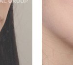 돌출입 때문에 <b>양악</b> 했어요!! ㅠ 흐아~