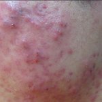 .여드름피부 관리, 모공, 홍<b>조증</b>!!!!!!!!!!!!!!!!!...