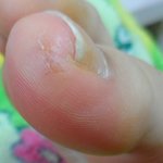(사진有)<b>엄지</b>발톱위에 뭐가났는데 너무간지러워요ㅠㅠ