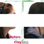 [성형이야기] 이마지방<b>이식</b>으로 연예인 같은 입체적인 얼굴 만들기...