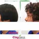 [성형이야기] 코성형하면 OOO한다던데... 코성형에 대한 속설...