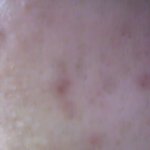 ★★★★★여드름과 이별했어요★★★★★