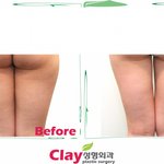[성형이야기] 지방<b>흡입</b> Season에 알아두면 좋은 정보!!!