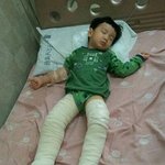 ★☆ 어린이집에서 3살도 안된 동생이 2도 화상을 입어왔어요 (사진有)