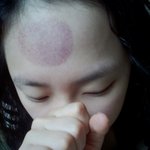 ★★★★★사진(有) 얼굴에 부황뜸ㅋㅋㅋㅋㅋㅋㅋㅋㅋㅋ★★★★★