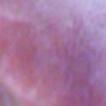 <b>매독</b> 증상?