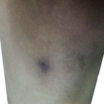 [사진有]무릎 <b>흉터</b> 많이 흉한가요?ㅠㅠㅠ