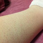 <b>닭살</b>피부 ㅠㅠㅠ봐주세요 사진有