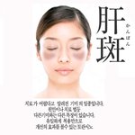 기미는 임산부만 생기는게 아니더이다