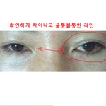 쌍꺼풀 수술 부작용 甲(스압)
