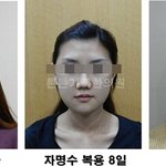 [성형붓기 주치의] "왜 나만 안빠질까..?" 성형수술 후 가장...