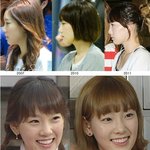 태연성형의혹