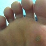 혐오有))) 티눈밴드로 티눈완치함 으캬컄!!!!