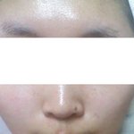 사진有)<b>좁쌀</b>여드름에대해 질문좀할께요!