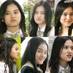 <b>양악</b>수술 많이 부작용있을까요