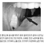<b>편도</b>결석 ㅋㅋㅋㅋ