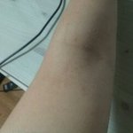 피부가;;<b>아토피</b>인가요?(혐오주의)