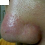<b>코</b>가 빨게졌는데 없어지질 않아요ㅠㅠ(<b>사진</b>)
