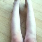 다리<b>흉터</b>