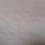 사진有))약혐)) 튼살 너무 걱정인데 ㅠㅠ 어떻게 해야하죠...