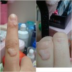 피부과에서 억울한 일을 당해었어요 ㅠㅠ 사마귀사진있으니 사진주의