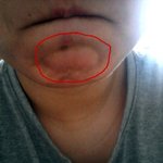 [사진有]  턱에 모기물렸어요ㅠㅠ
