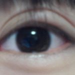 사진유)))모기가 제 쌍꺼풀을 물었어요ㅠㅠ