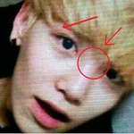 ★★★<b>b.a.p</b> 젤로도 수술했대요 흑흑 ★★★