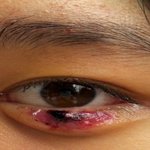 (사진수정)다래끼수술로흉진눈,손해<b>배상</b> 가능할까요?(사진有)