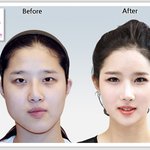 언니들..나 <b>양악</b>수술 할려는데 이성형외과 어때???