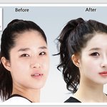 언니들 <b>양악</b>수술할려는데 여기 괜찮음?