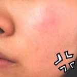 <b>홍조</b>가 너무 심해서요 -_ㅜ