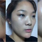 사진有) 23 女 무료 성형이벤트에 당첨!!!!!!!!!!