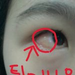 <b>눈알</b>이 튀어나왔어요,,도와주세요ㅠ