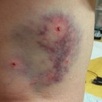 [사진有] 주인집 개한테 물려서 응급실에 다녀온 사연.