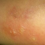 *약간 혐오* 모기물렷는데 부어서 <b>물집</b>같은게 3개 잡혓어요ㅠㅠ