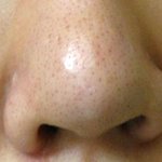 <b>레알</b>혐오사진有)언니들 나같은블랙헤드 탈출한사람 없어..?하..