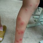 징그러움/사진 有)제 친구가 모기한테 <b>테러</b>당함
