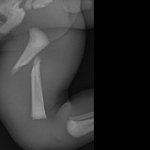 신생아 대퇴부 골절.  <b>배속</b>에서 부러졌다네요.