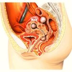 자궁<b>근종</b>, 자궁물혹의 원인과 증상, 치료&amp;예방법