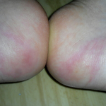 사진 有  *혐오?*<b>발쪽</b>에 모기 물린거에요?쓸린거에요?