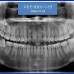 ★울산 <b>모</b> 치과에서 <b>교정</b>치료중 턱이빠졌어요 도와주세요★사진有