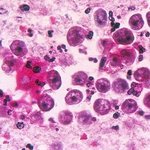 뇌먹는 아메바 (치사율 95%)베트남 비상