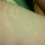 사진有 혐오주의] 허벅지<b>안쪽</b> 튼살..