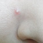 갑자기 올라온 트러블 흉터 없이 하루만에 가라 앉히기 (100%리얼사진)
