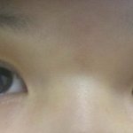 사진有)방금쌍커풀<b>수술</b>하고왔는데 봐주세요