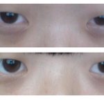 (혐) 앞트임 vs 지방<b>재배치</b>