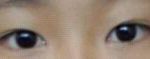 <b>쌍수</b>후기!!!
